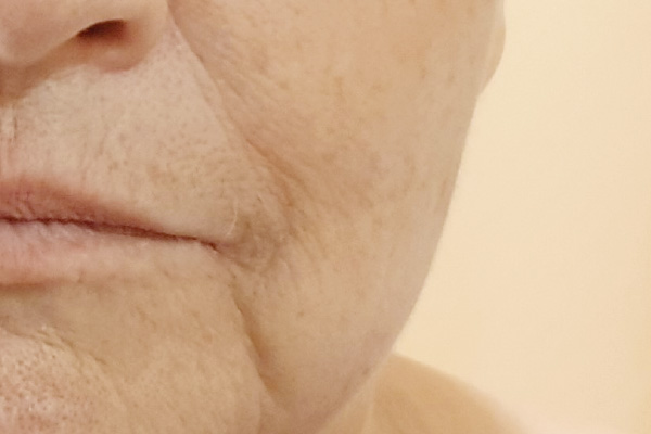 Caso de lifting facial antes