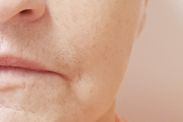 Caso de lifting facial depois