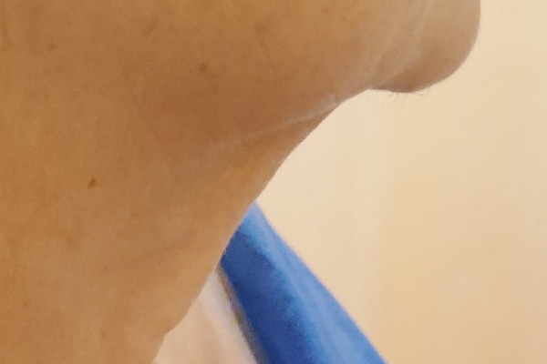 Caso de lifting facial antes