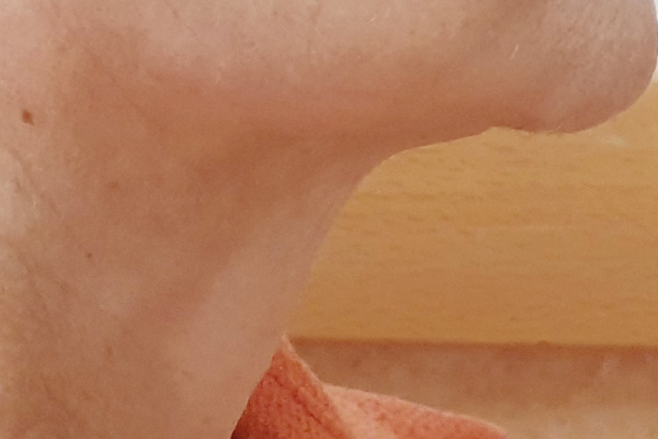 Caso de lifting facial depois