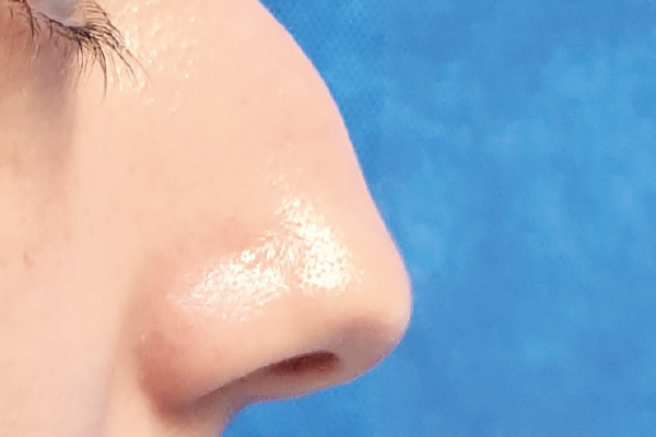 Caso de lifting facial antes