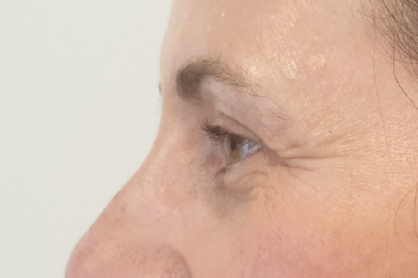 Caso de lifting facial depois