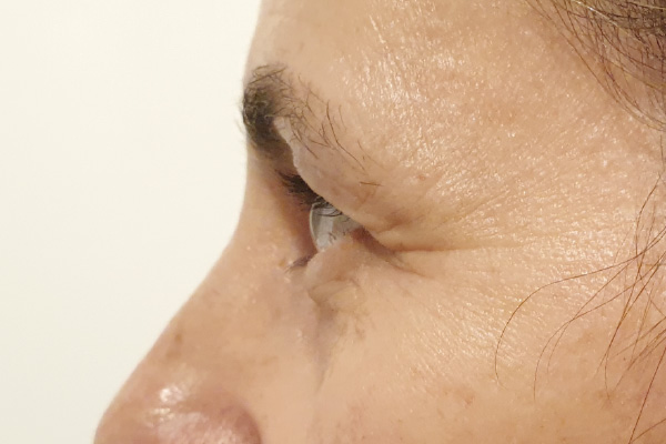 Caso de lifting facial antes