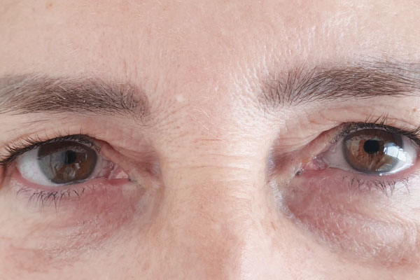 Caso de lifting facial antes