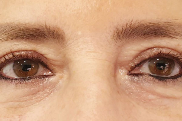 Caso de lifting facial depois