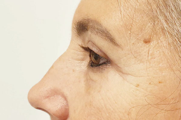 Caso de lifting facial depois