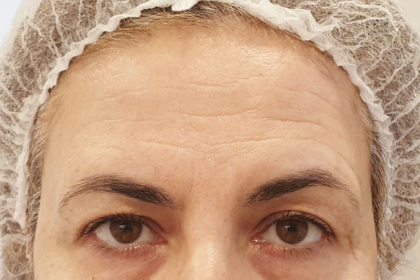 Caso de lifting facial antes