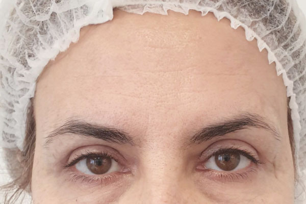 Caso de lifting facial depois