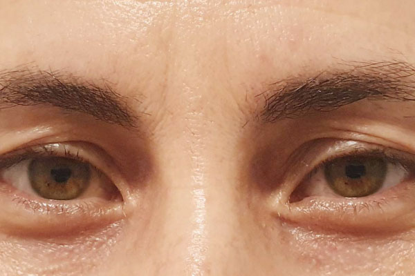 Caso de lifting facial antes