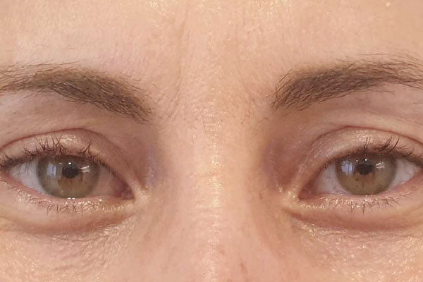 Caso de lifting facial depois