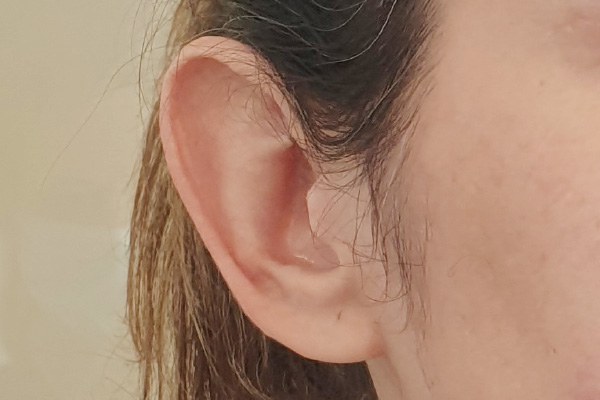 Caso de lifting facial antes