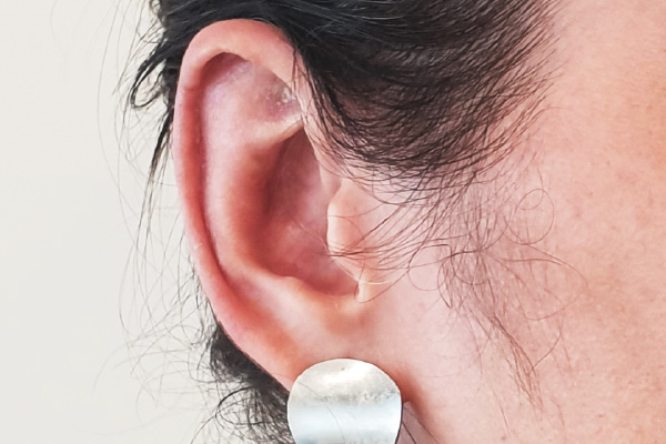 Caso de lifting facial depois