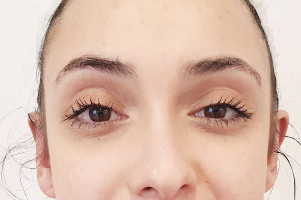 Caso de lifting facial depois