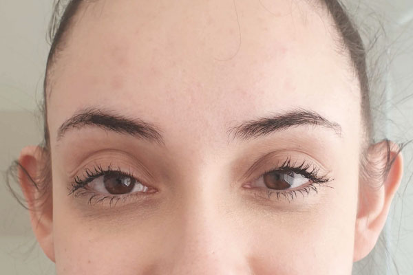 Caso de lifting facial antes