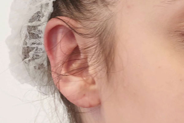 Caso de lifting facial depois