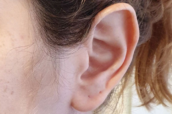 Caso de lifting facial antes