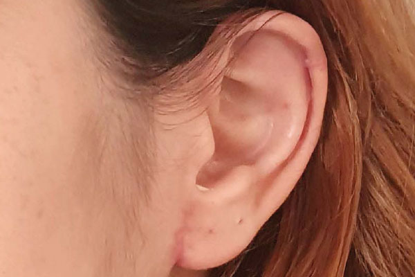 Caso de lifting facial depois