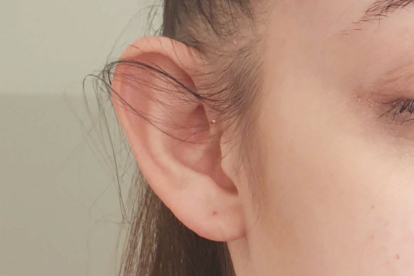 Caso de lifting facial antes