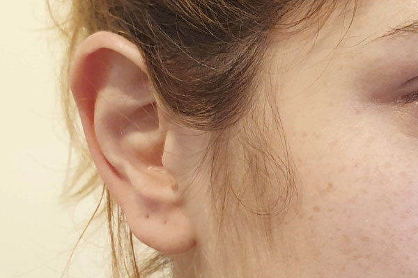 Caso de lifting facial antes