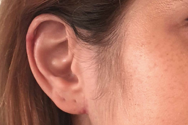 Caso de lifting facial depois