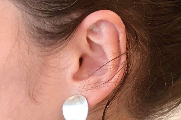 Caso de lifting facial depois