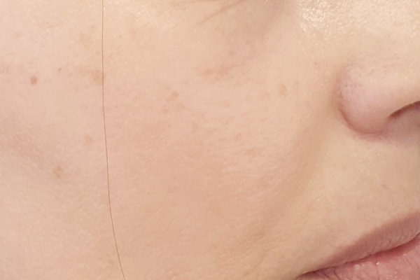 Caso de lifting facial depois