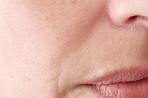 Caso de lifting facial antes