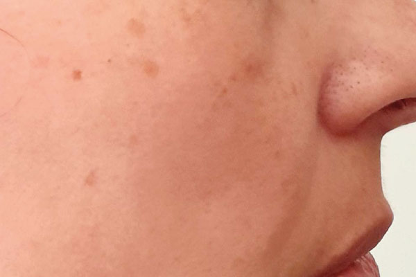 Caso de lifting facial antes