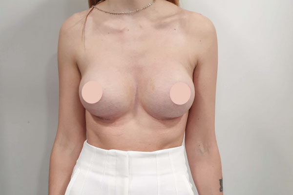 Caso de lifting facial depois