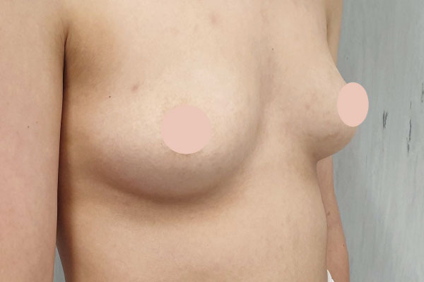 Caso de lifting facial antes