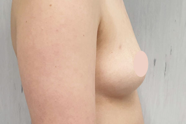 Caso de lifting facial antes