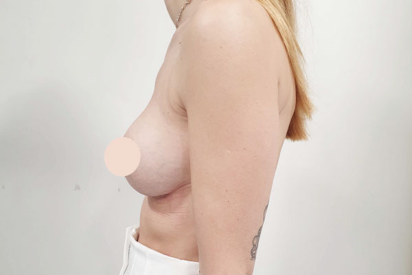 Caso de lifting facial depois