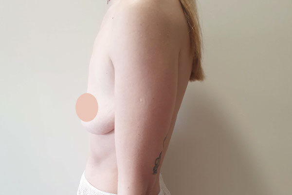 Caso de lifting facial antes