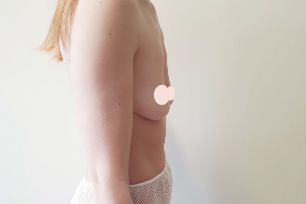 Caso de lifting facial antes