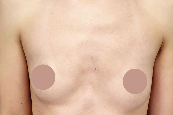 Caso de lifting facial antes