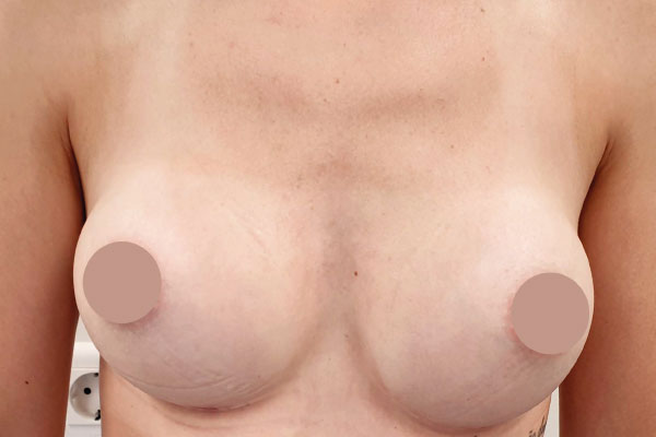 Caso de lifting facial depois