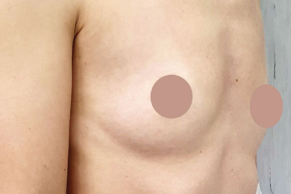 Caso de lifting facial antes