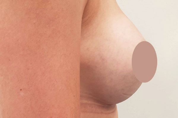 Caso de lifting facial depois