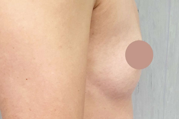 Caso de lifting facial antes