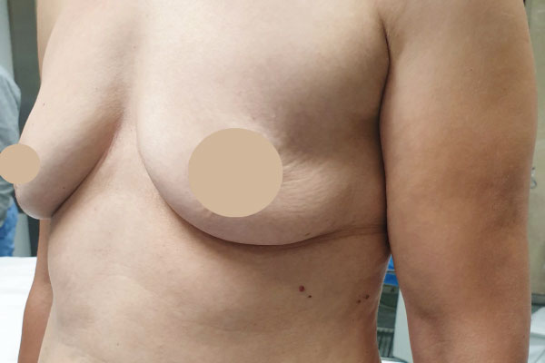 Caso de lifting facial antes