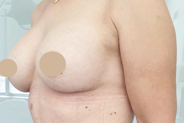 Caso de lifting facial depois