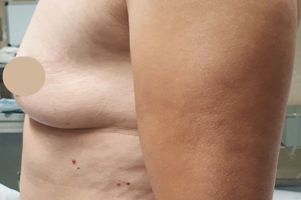 Caso de lifting facial antes