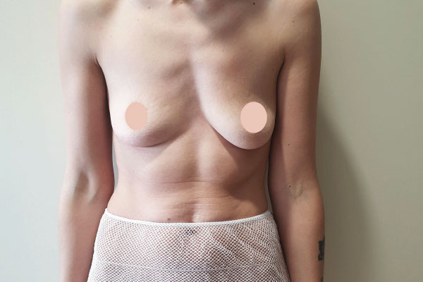 Caso de lifting facial antes