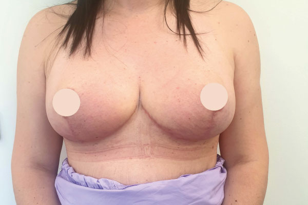 Caso de lifting facial depois