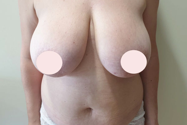 Caso de lifting facial antes