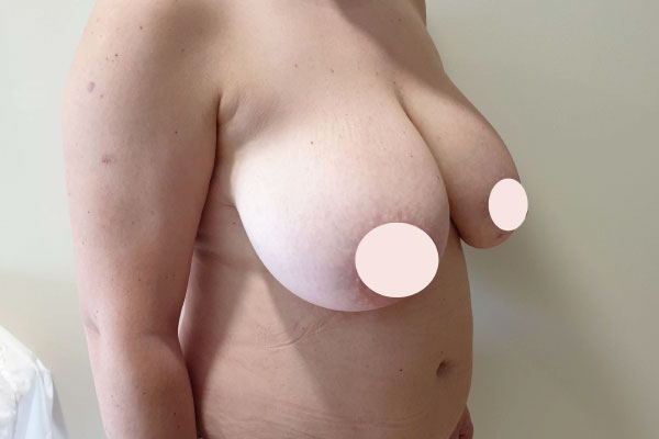 Caso de lifting facial antes