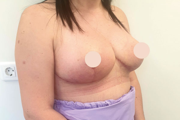 Caso de lifting facial depois