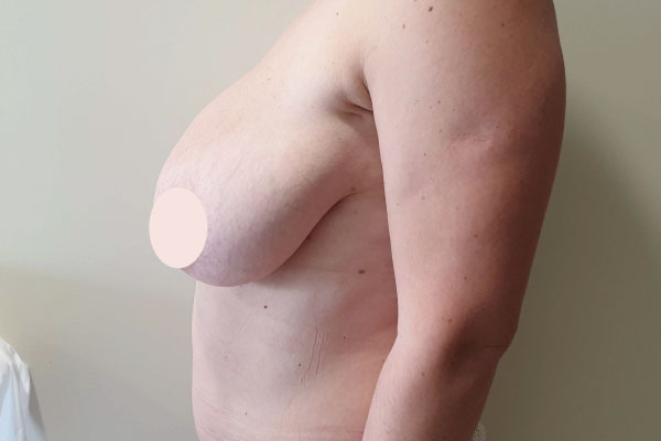 Caso de lifting facial antes