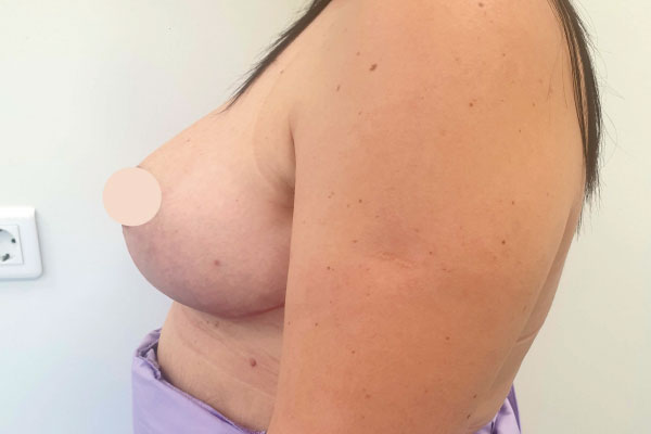 Caso de lifting facial depois