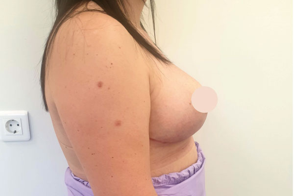 Caso de lifting facial depois